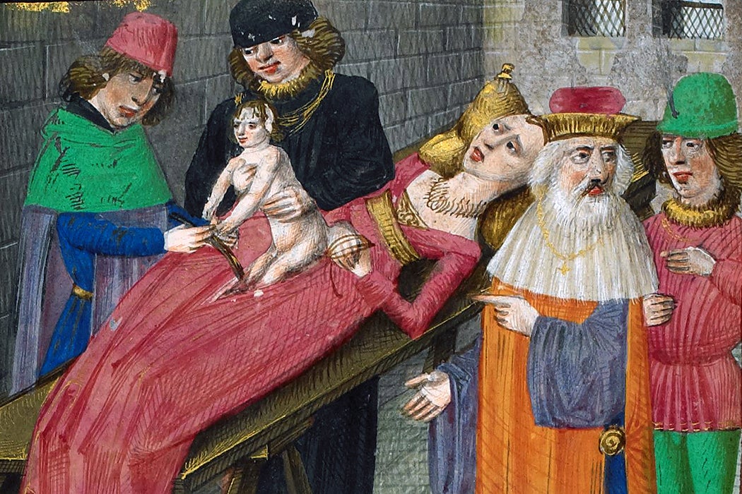 Medieval depiction of Caesarian birth