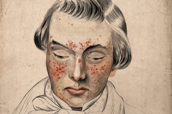 Illustration: Head of a man with a severe disease affecting his face by Christopher D' Alton, 1858

Source: https://www-jstor-org.ezproxyberklee.flo.org/stable/community.24834473