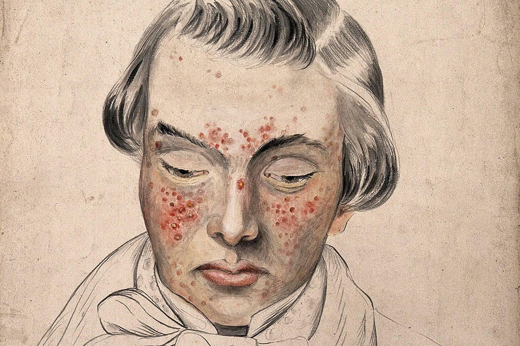 Illustration: Head of a man with a severe disease affecting his face by Christopher D' Alton, 1858

Source: https://www-jstor-org.ezproxyberklee.flo.org/stable/community.24834473